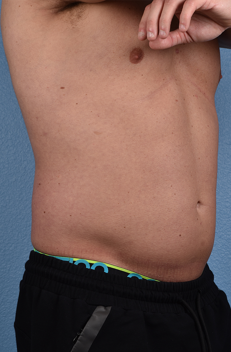 Liposuction Before & After Gallery - Patient 267185 - Image 5
