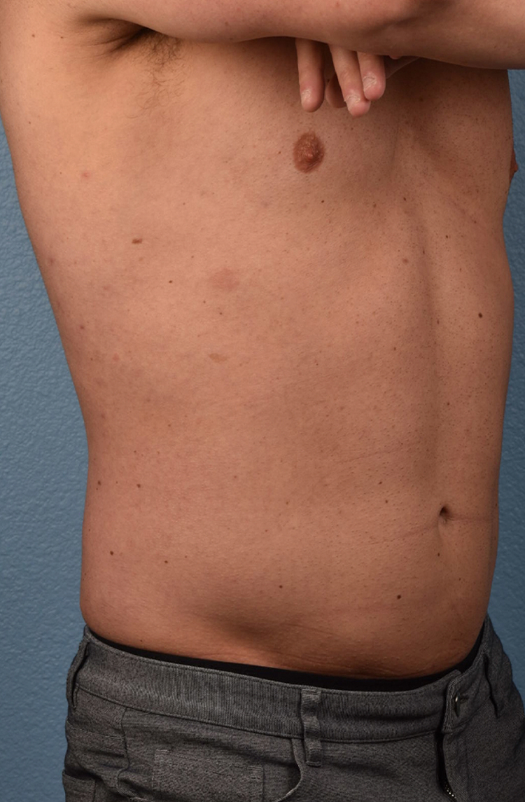 Liposuction Before & After Gallery - Patient 267185 - Image 6