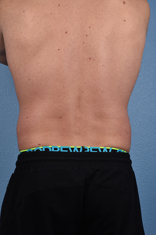 Liposuction Before & After Gallery - Patient 267185 - Image 7