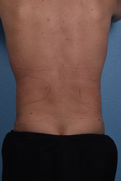Liposuction Before & After Gallery - Patient 267185 - Image 8