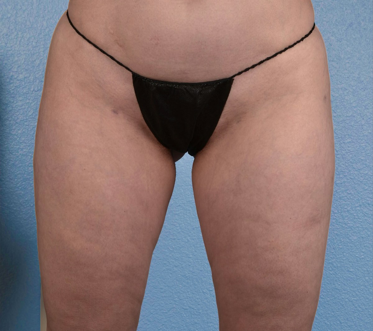 Liposuction Before & After Gallery - Patient 464332 - Image 2