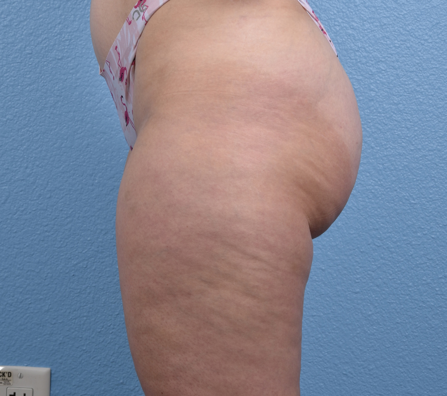 Liposuction Before & After Gallery - Patient 464332 - Image 5