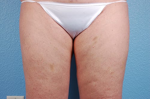 Hidden Patients Before & After Gallery - Patient 113163 - Image 1