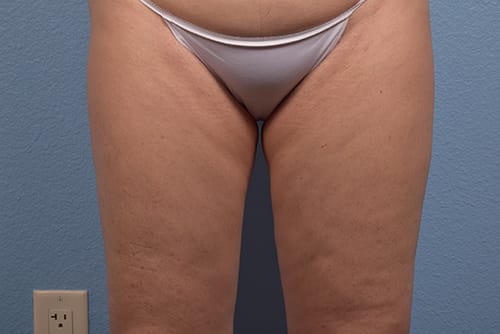 Hidden Patients Before & After Gallery - Patient 113163 - Image 2