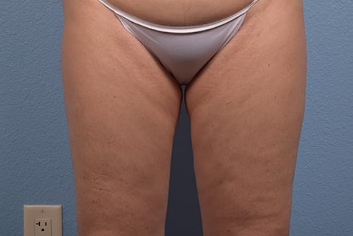Liposuction Before & After Gallery - Patient 134071 - Image 2