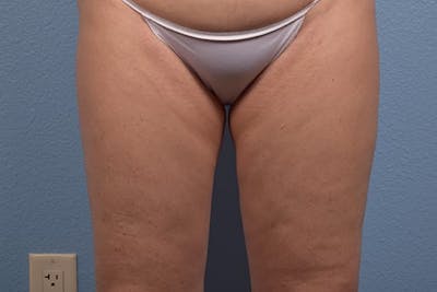 Liposuction Before & After Gallery - Patient 134071 - Image 2