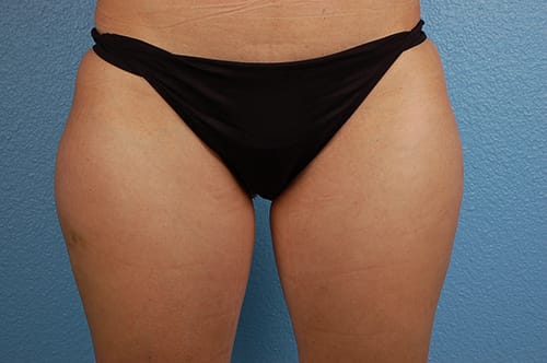 Liposuction Before & After Gallery - Patient 303157 - Image 1
