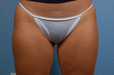 Liposuction Before & After Gallery - Patient 303157 - Image 2