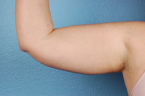 Liposuction Before & After Gallery - Patient 329177 - Image 1