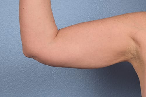 Liposuction Before & After Gallery - Patient 329177 - Image 2