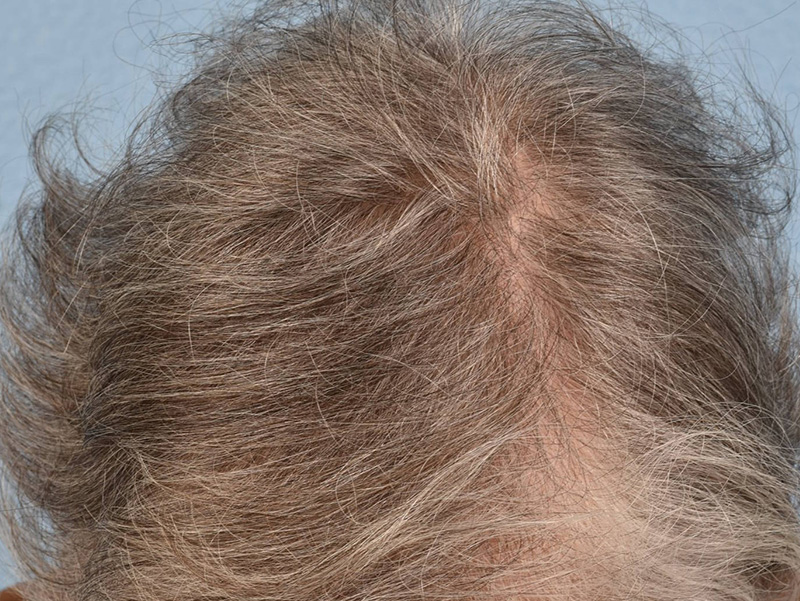 Hair Rejuvenation With PRP Before & After Gallery - Patient 592519 - Image 1
