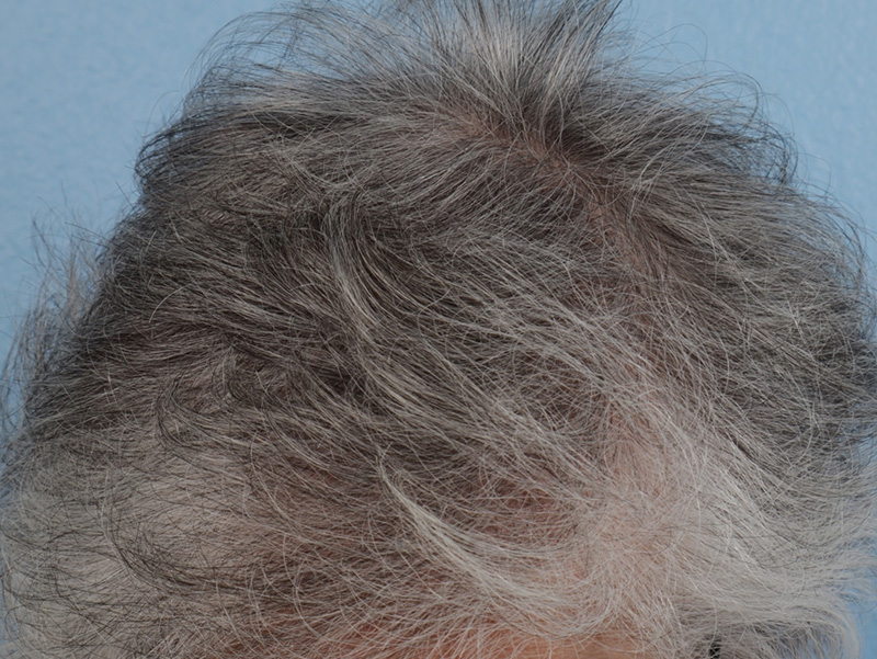 Hair Rejuvenation With PRP Before & After Gallery - Patient 592519 - Image 2