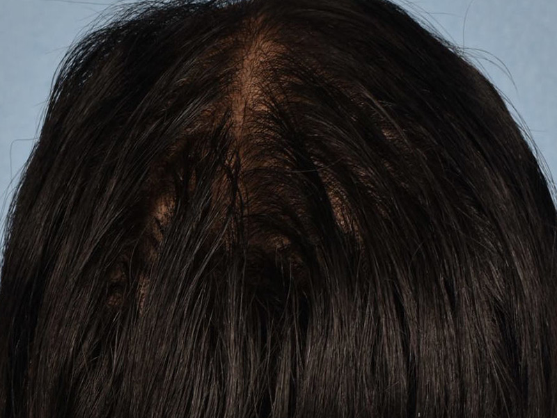 Hair Rejuvenation With PRP Before & After Gallery - Patient 291923 - Image 1