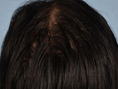 Hair Rejuvenation With PRP Before & After Gallery - Patient 291923 - Image 1