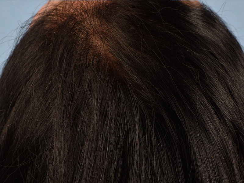 Hair Rejuvenation With PRP Before & After Gallery - Patient 291923 - Image 2