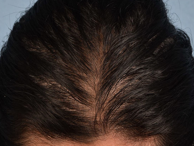 Hair Rejuvenation With PRP Before & After Gallery - Patient 291923 - Image 3