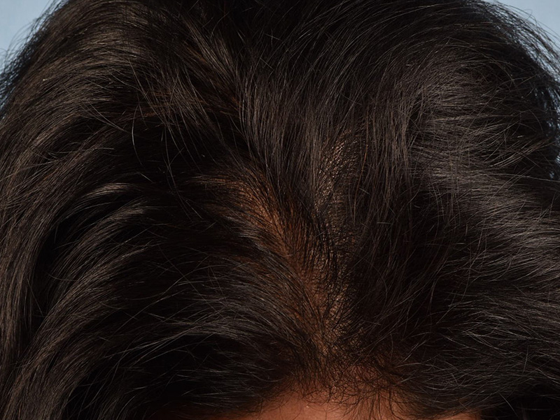 Hair Rejuvenation With PRP Before & After Gallery - Patient 291923 - Image 4