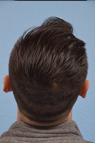 Hair Transplant With NeoGraft Before & After Gallery - Patient 494446 - Image 1
