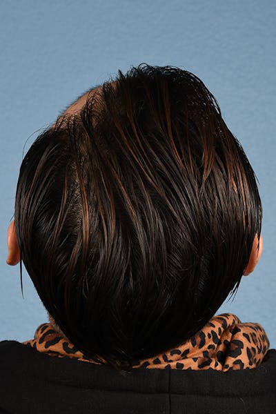 Hair Transplant With NeoGraft Before & After Gallery - Patient 494446 - Image 2