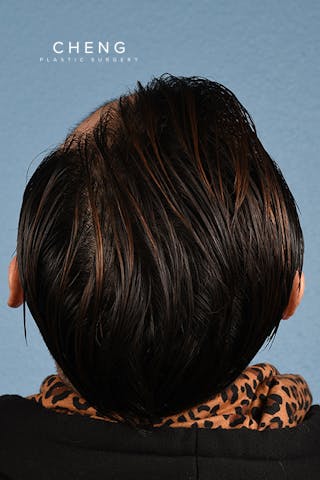 Hidden Patients Before & After Gallery - Patient 381194 - Image 2