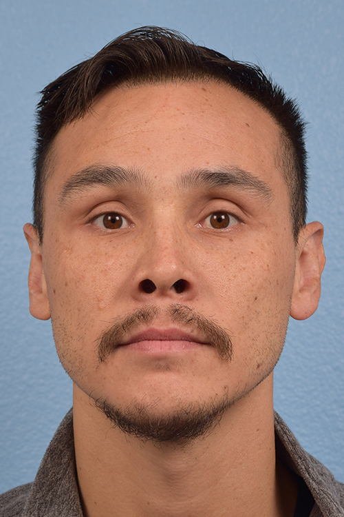 Hair Transplant With NeoGraft Before & After Gallery - Patient 494446 - Image 1