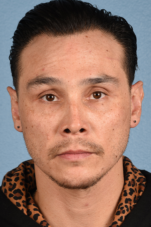 Hair Transplant With NeoGraft Before & After Gallery - Patient 494446 - Image 2