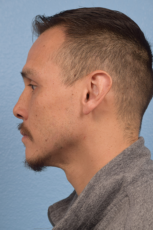 Hair Transplant With NeoGraft Before & After Gallery - Patient 494446 - Image 3