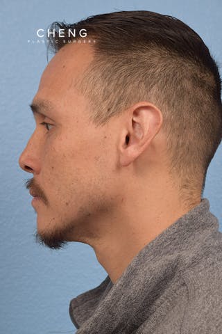 Hidden Patients Before & After Gallery - Patient 381194 - Image 5