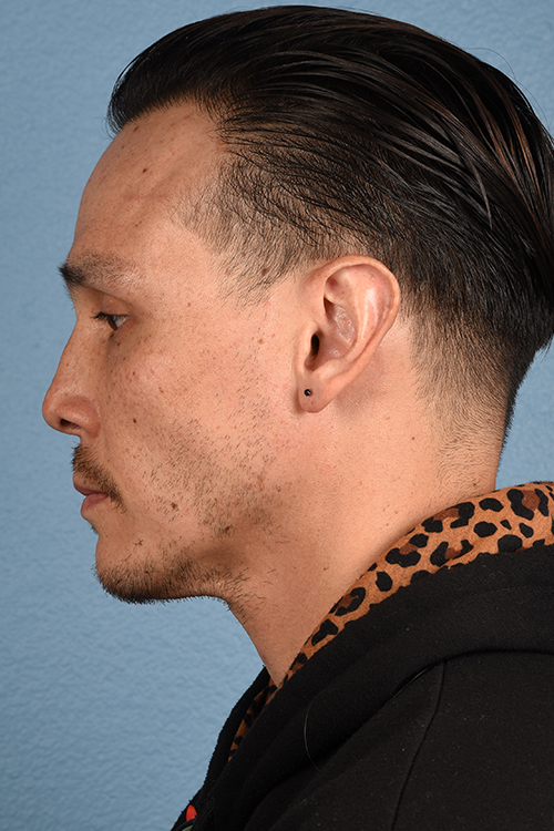 Hair Transplant With NeoGraft Before & After Gallery - Patient 494446 - Image 4