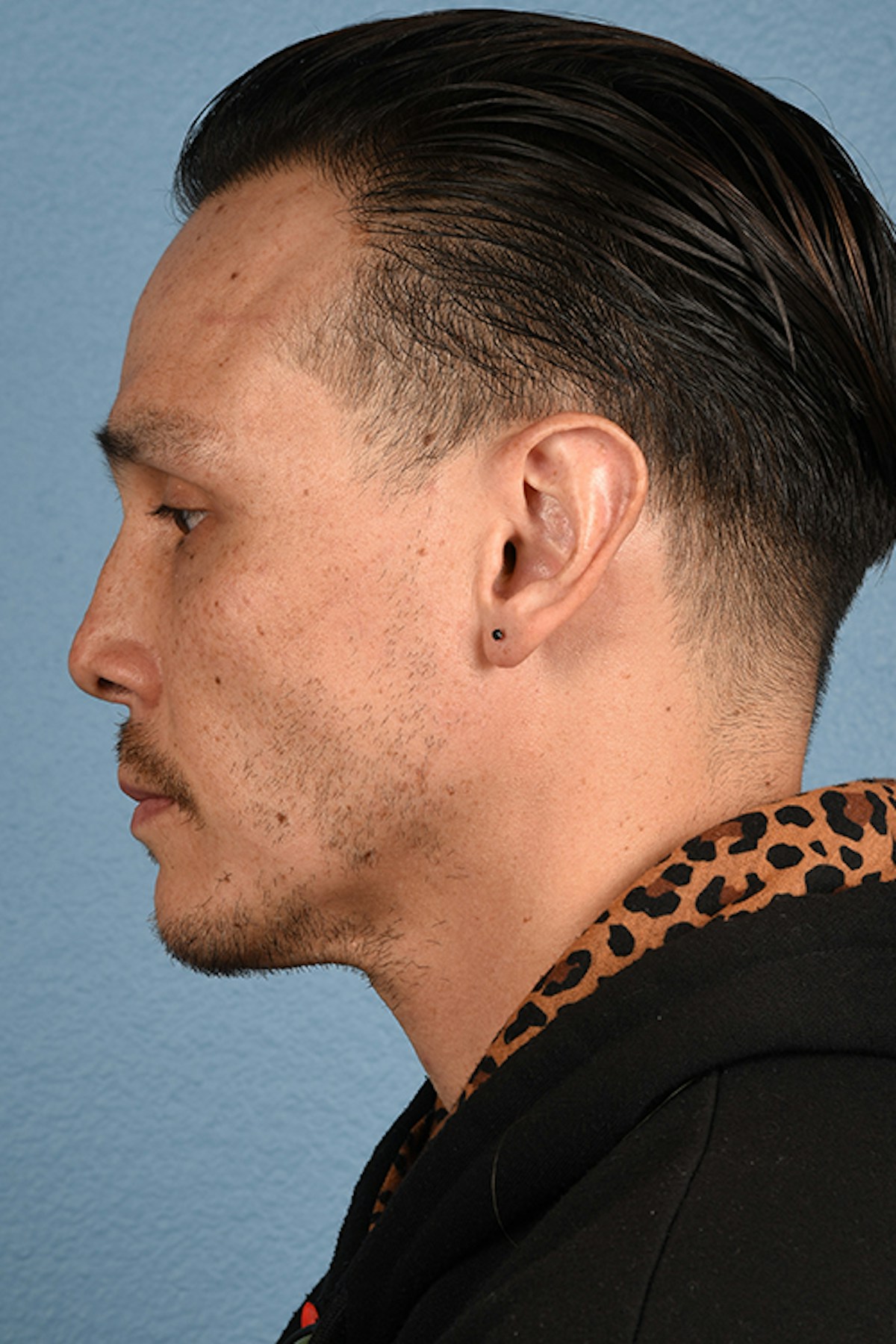 Hair Transplant With NeoGraft Before & After Gallery - Patient 494446 - Image 6