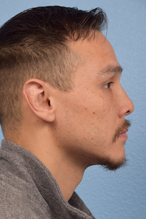 Hair Transplant With NeoGraft Before & After Gallery - Patient 494446 - Image 5