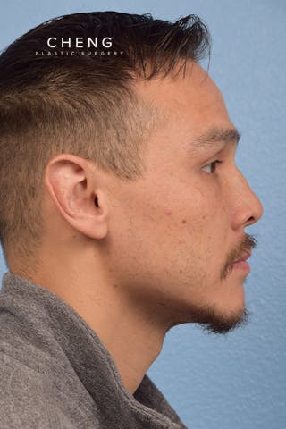 Hidden Patients Before & After Gallery - Patient 381194 - Image 7