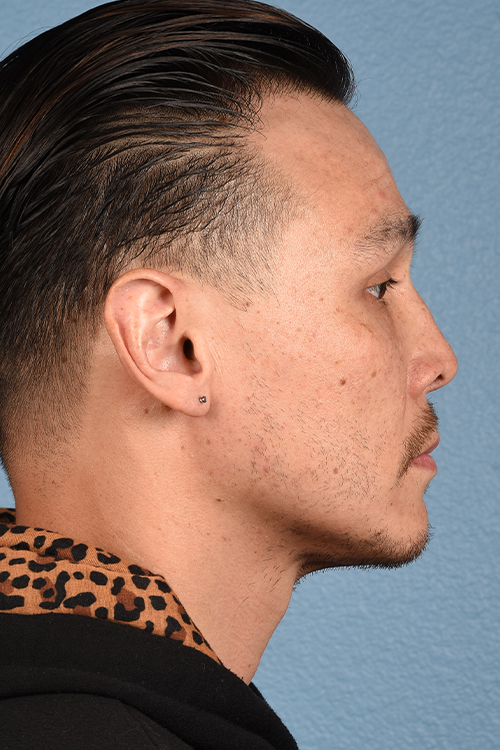 Hair Transplant With NeoGraft Before & After Gallery - Patient 494446 - Image 6