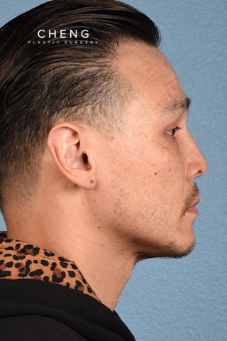 Hidden Patients Before & After Gallery - Patient 381194 - Image 8
