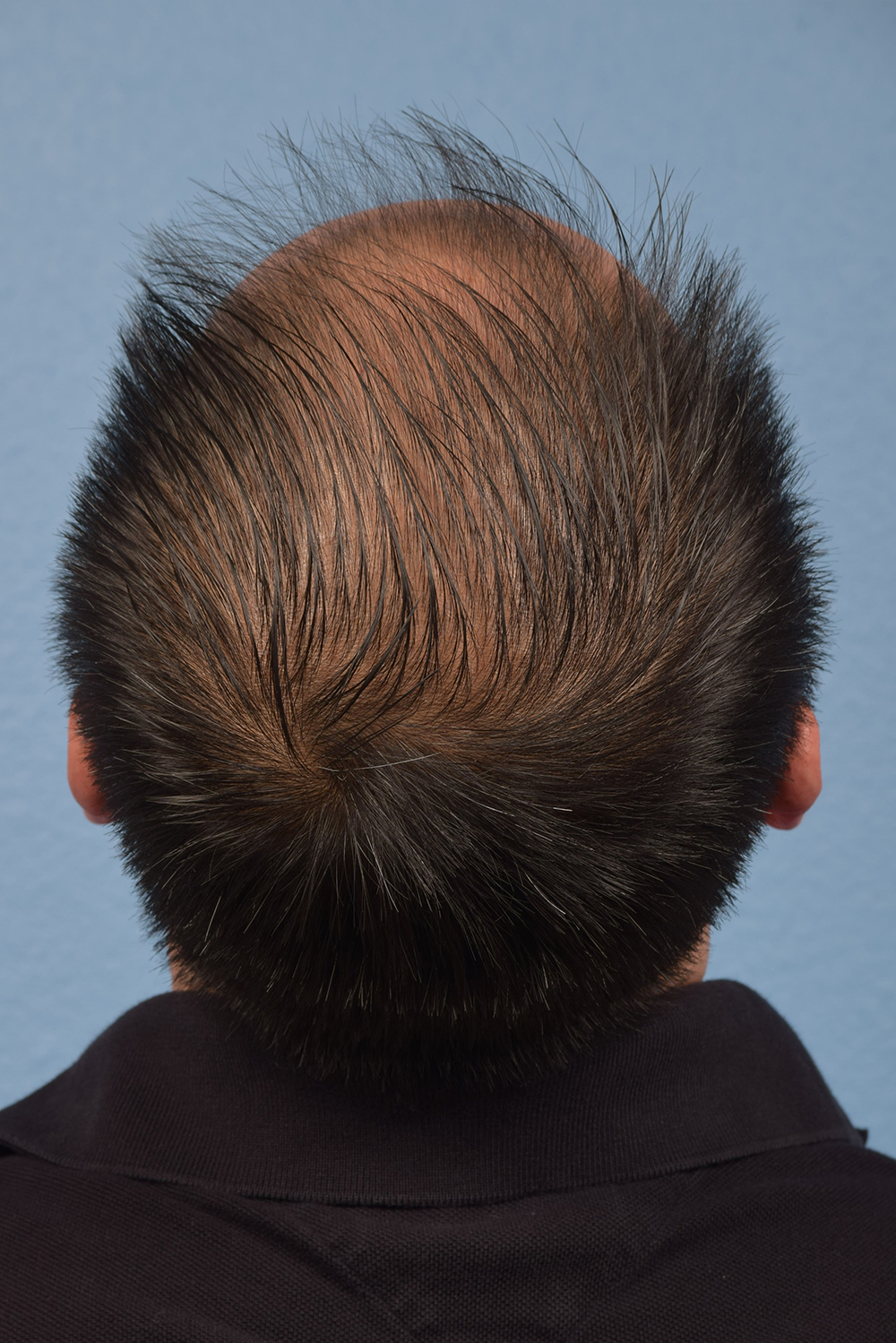 Hair Transplant With NeoGraft Before & After Gallery - Patient 242971 - Image 3