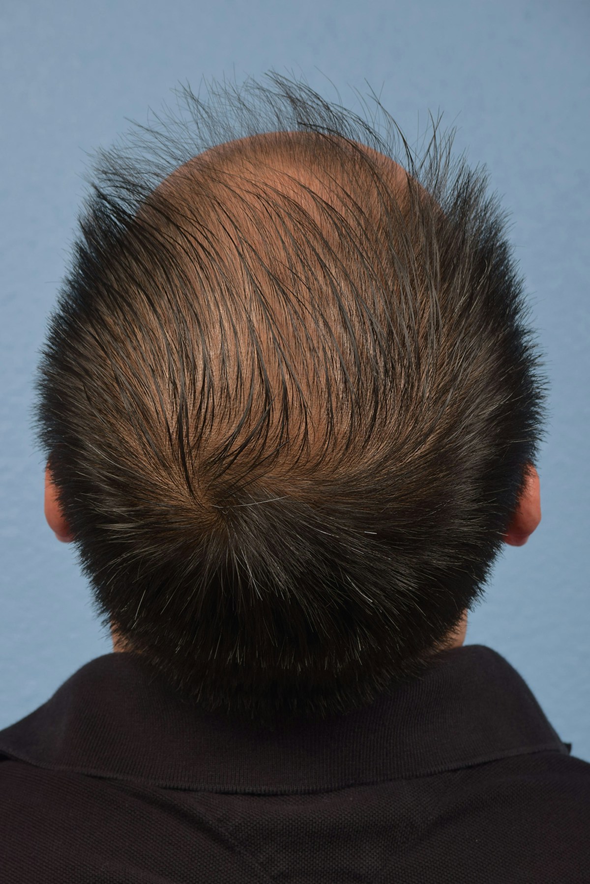 Hair Transplant With NeoGraft Before & After Gallery - Patient 242971 - Image 1