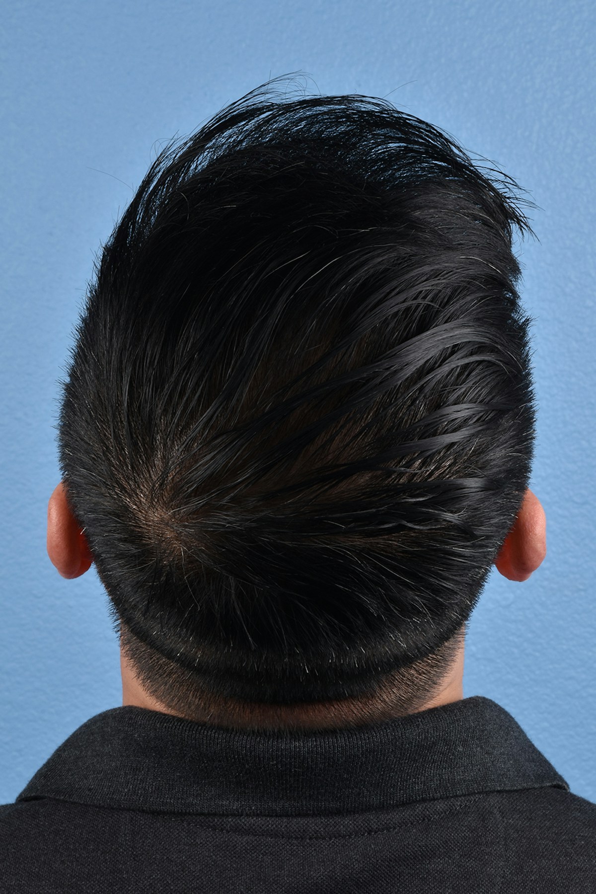 Hair Transplant With NeoGraft Before & After Gallery - Patient 242971 - Image 2