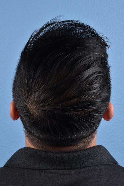 Hair Transplant With NeoGraft Before & After Gallery - Patient 242971 - Image 2