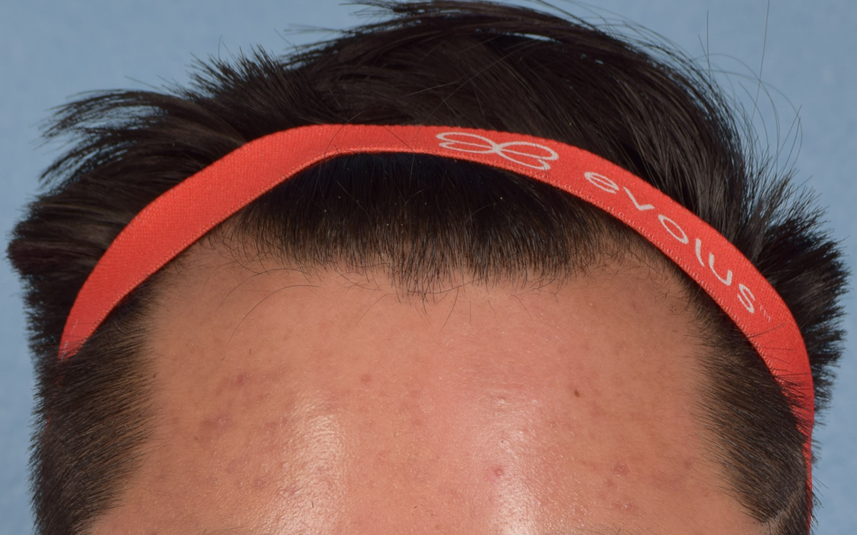 Hair Transplant With NeoGraft Before & After Gallery - Patient 421962 - Image 1