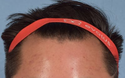 Hair Transplant With NeoGraft Before & After Gallery - Patient 421962 - Image 1