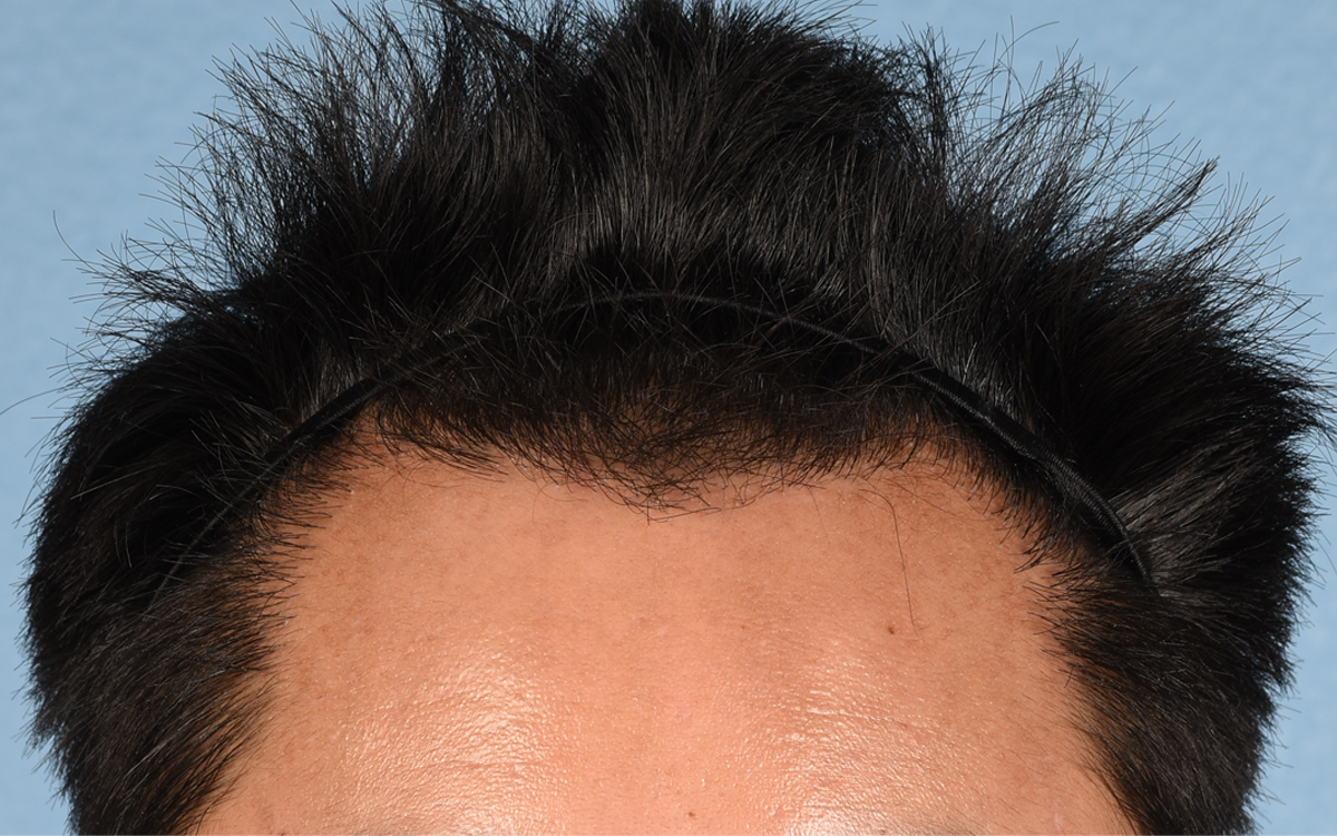 Hair Transplant With NeoGraft Before & After Gallery - Patient 421962 - Image 2