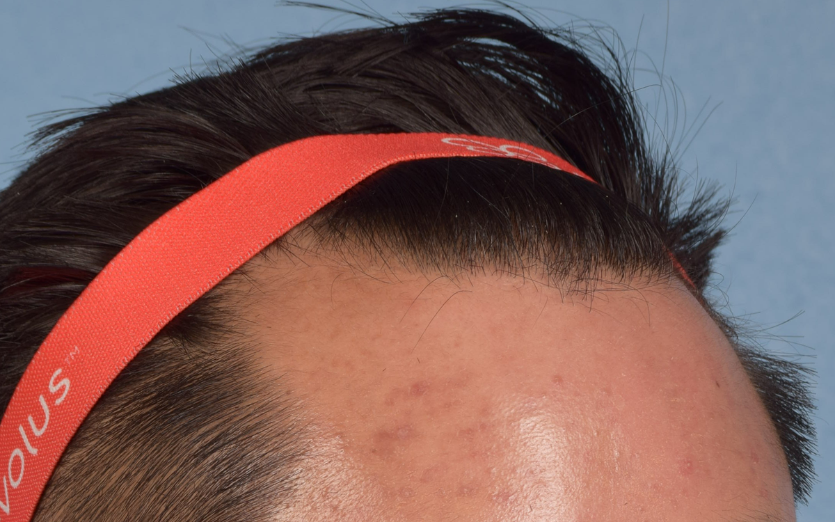 Hair Transplant With NeoGraft Before & After Gallery - Patient 421962 - Image 3