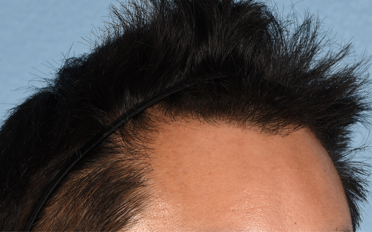 Hair Transplant With NeoGraft Before & After Gallery - Patient 421962 - Image 4