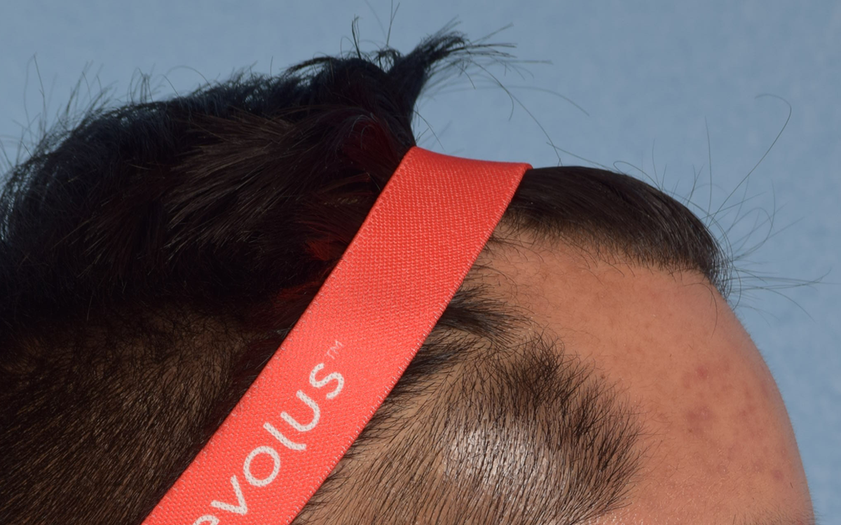 Hair Transplant With NeoGraft Before & After Gallery - Patient 421962 - Image 5