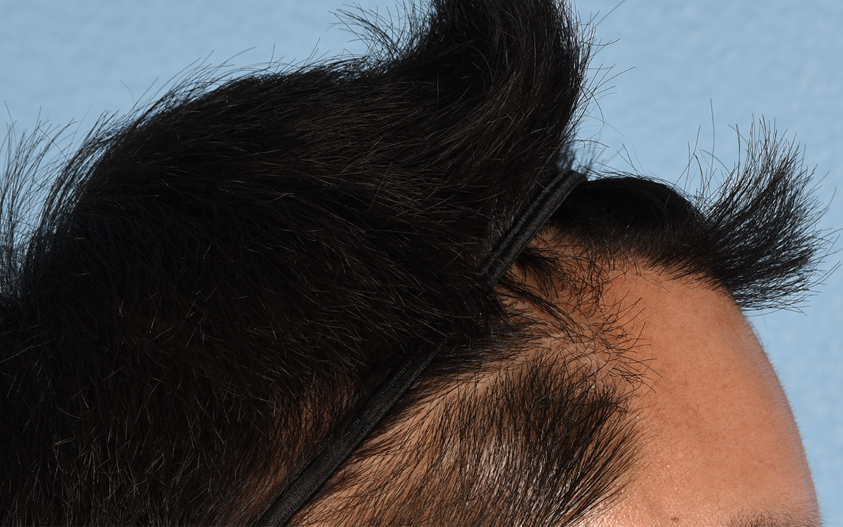 Hair Transplant With NeoGraft Before & After Gallery - Patient 421962 - Image 6