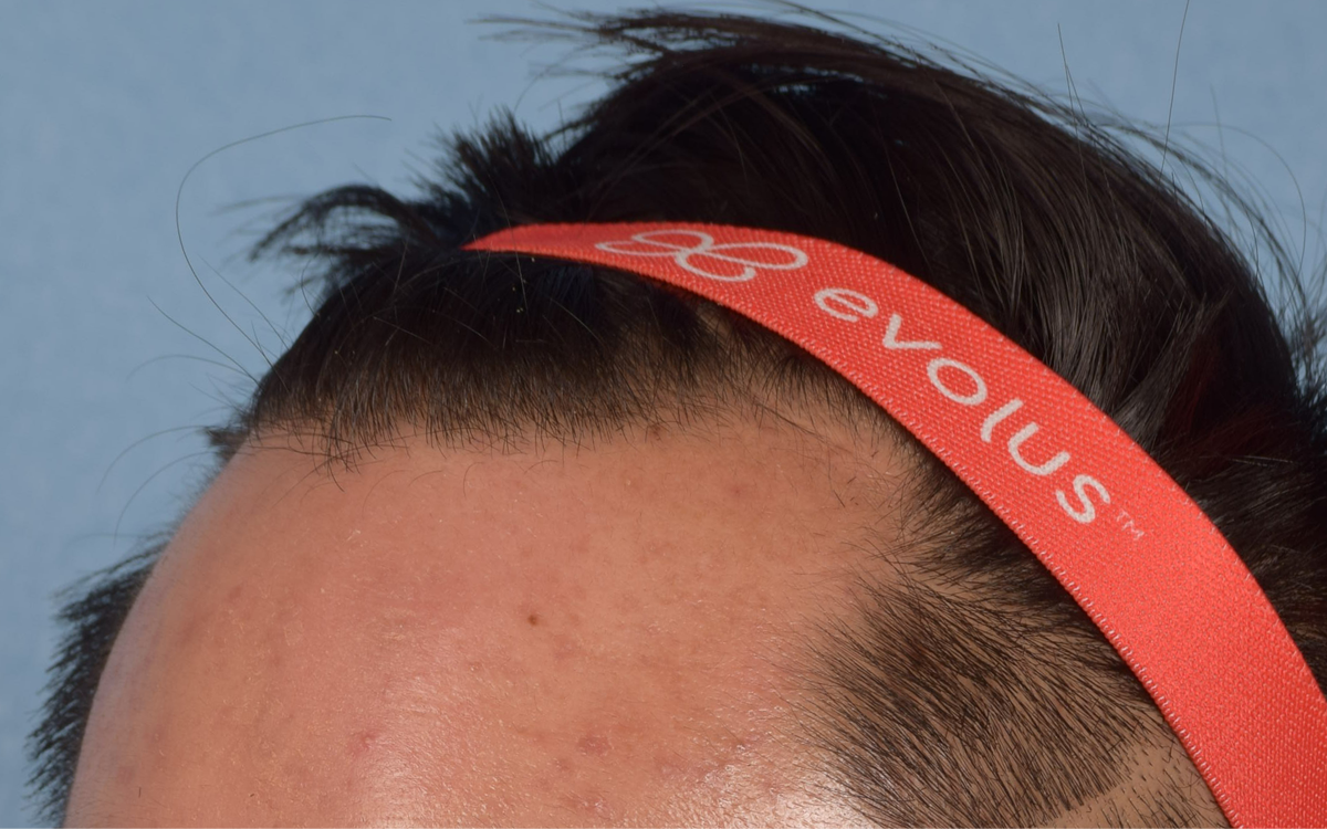 Hair Transplant With NeoGraft Before & After Gallery - Patient 421962 - Image 7