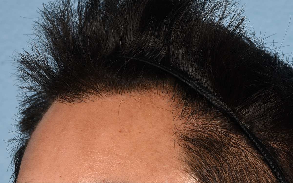 Hair Transplant With NeoGraft Before & After Gallery - Patient 421962 - Image 8