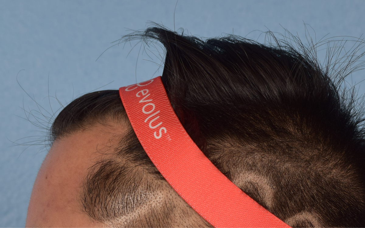 Hair Transplant With NeoGraft Before & After Gallery - Patient 421962 - Image 9