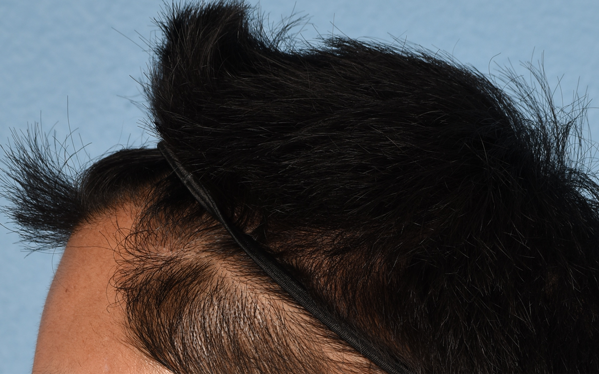 Hair Transplant With NeoGraft Before & After Gallery - Patient 421962 - Image 10