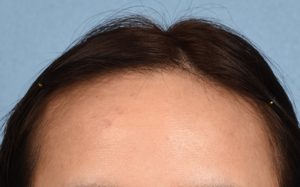 Hair Transplant With NeoGraft Before & After Gallery - Patient 984625 - Image 1